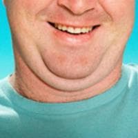 profile_Double Chin