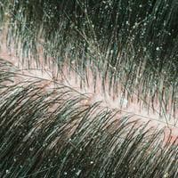 Dandruff type de personnalité MBTI image